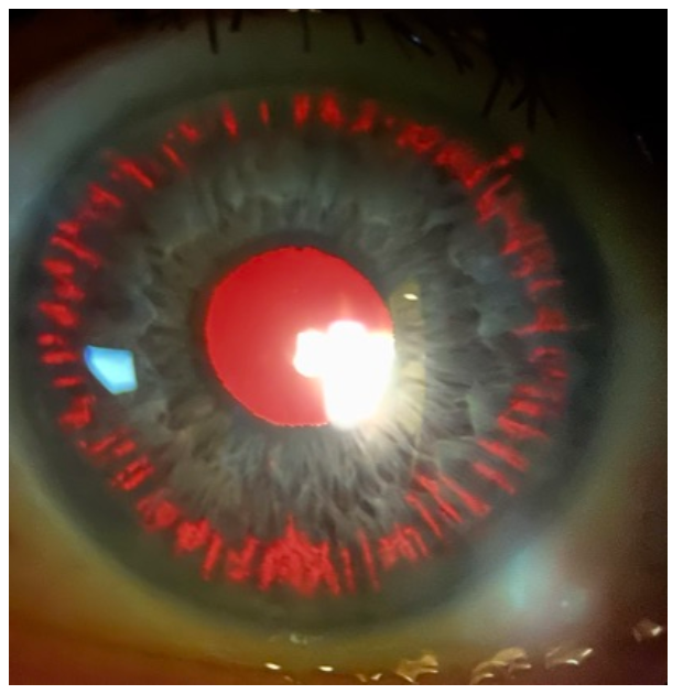 Pigmentary Glaucoma and Pigmentary Dispersion Syndrome