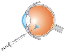 Repeated anti-VEGF injections may increase glaucoma risk