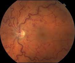 Retinal vein occlusion may be helped by new eye drops