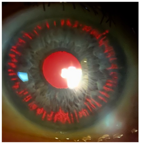 Defect In The Iris Pigmentary Glaucoma and Pigmentary Dispersion Syndrome