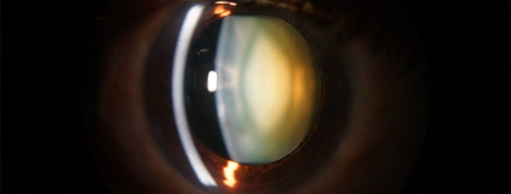 Cataracts vs Glaucoma: What’s the Difference?
