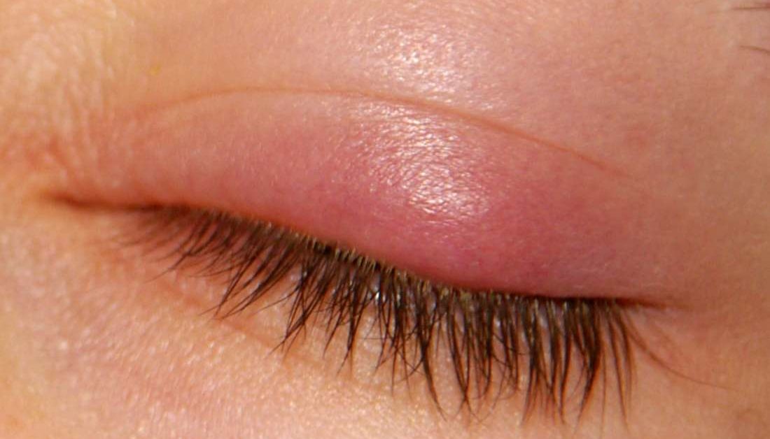A Stye is Not an Infection - Treatment Pearls