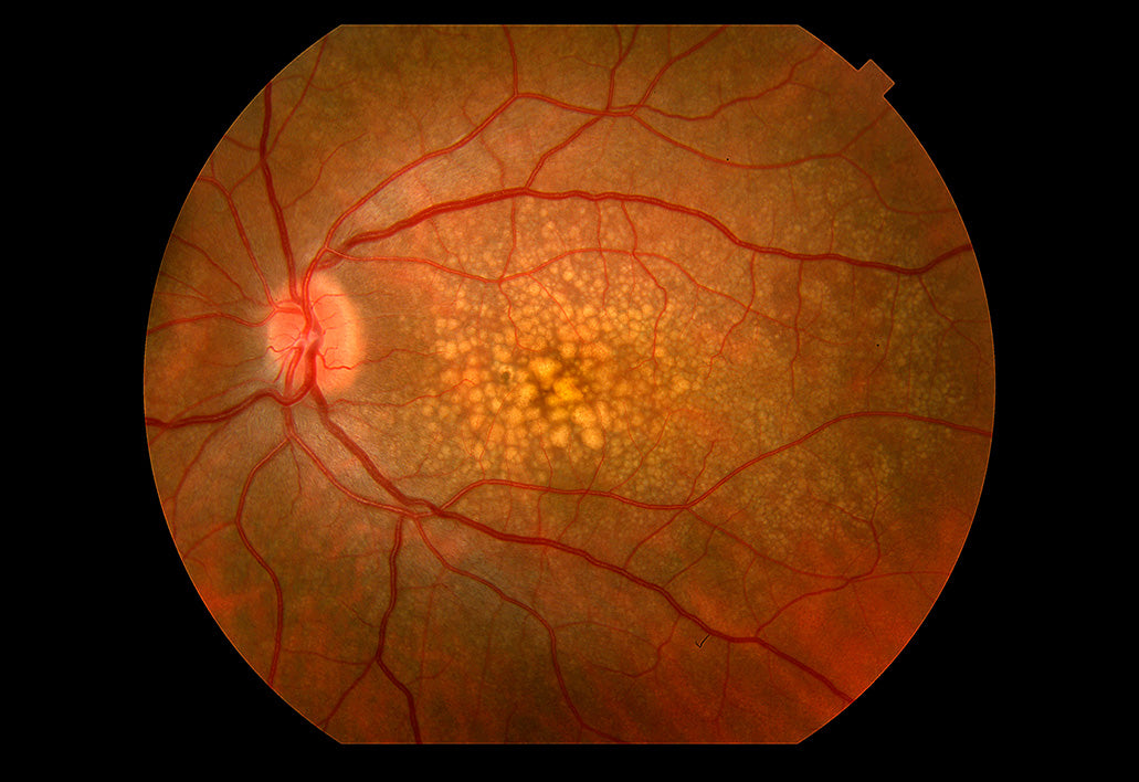 Drusen Eye Problem in Age-Related Macular Degeneration