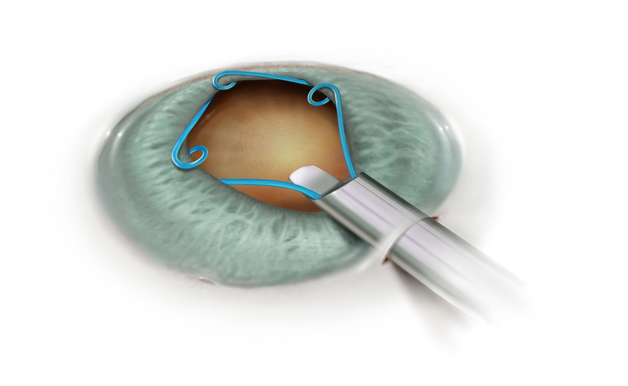Why do Flomax commercials contain a warning about Cataract Surgery?