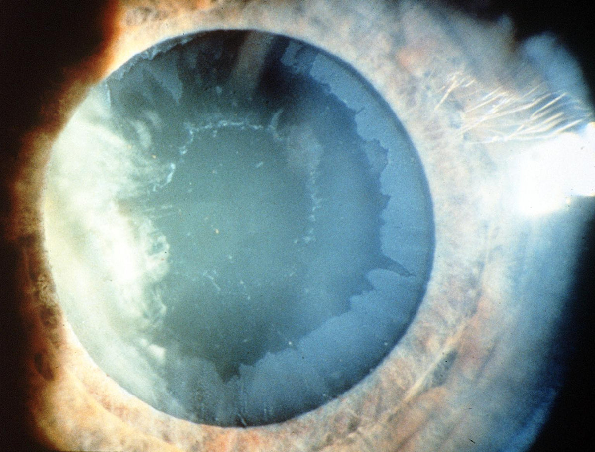 Pseudoexfoliation Syndrome pseudoexfoliation-syndrome