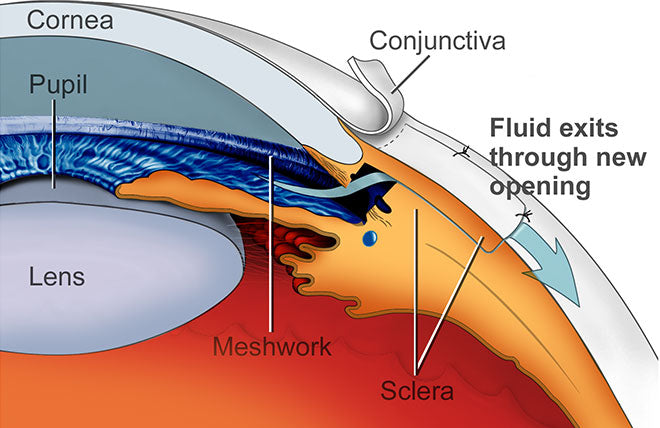 Glaucoma Surgery combined with Cataract Surgery
