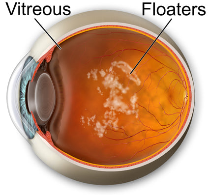Non-Surgical Management of Eye Floater Symptoms
