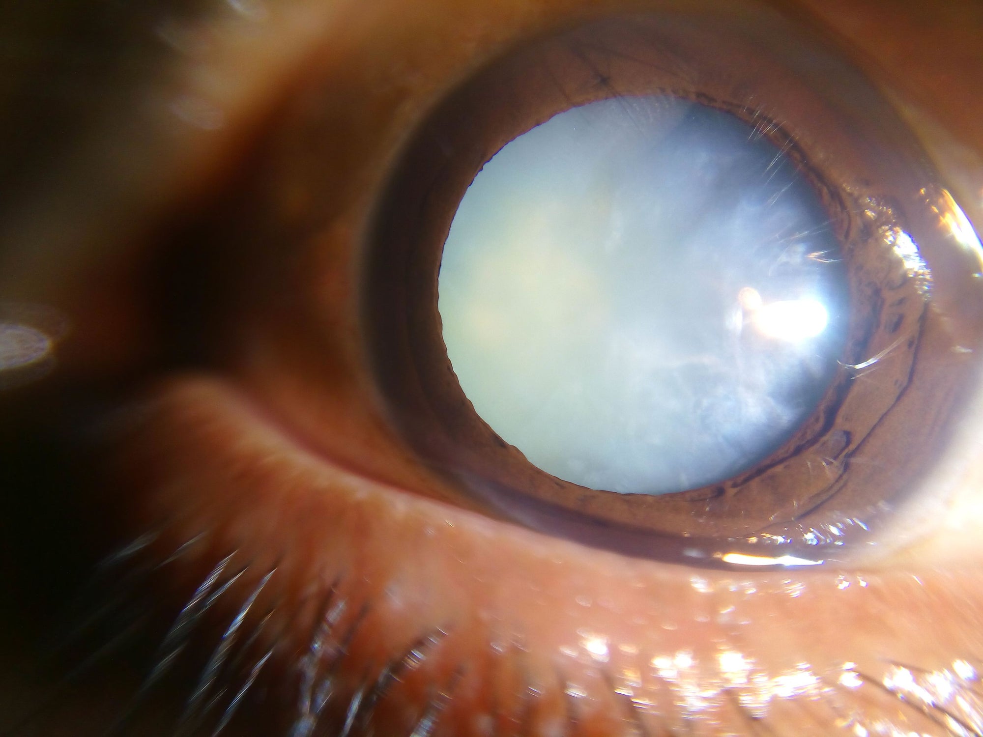 Should you choose a premium lens for your cataract surgery?
